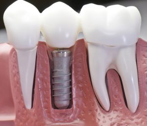 Dental Implants